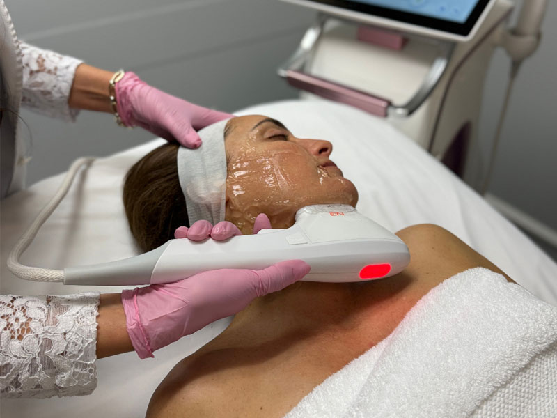 Photo showing a facial HIFU Treatment