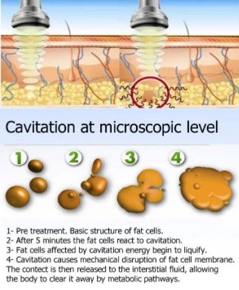 Ultrasound Cavitation!  Ultrasonic cavitation, Body treatments